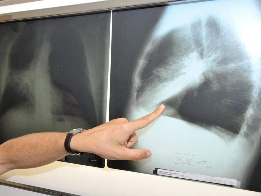 Ein Arzt zeigt auf ein Röntgenbild einer von Krebs befallenen Lunge. Foto: Felix Hörhager/Archivbild