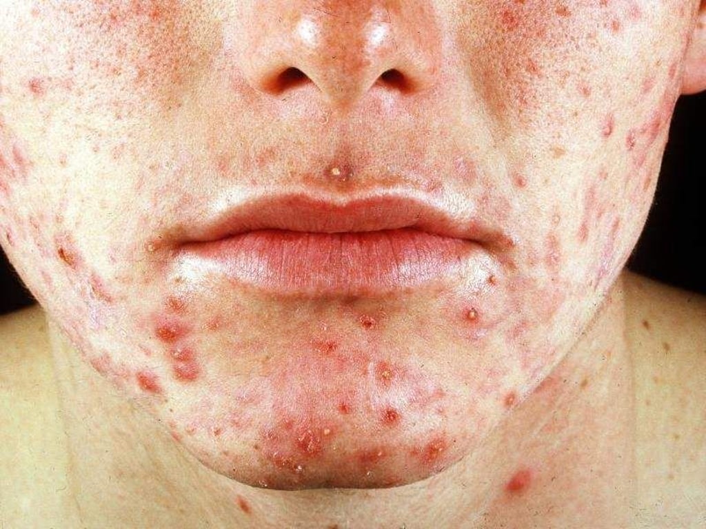 SOS bei Pickeln: Pflaster helfen gegen Unreinheiten. Bei verletzter Haut sollte man sie allerdings nicht benutzen. Foto: Hautklinik Universität Düsseldorf