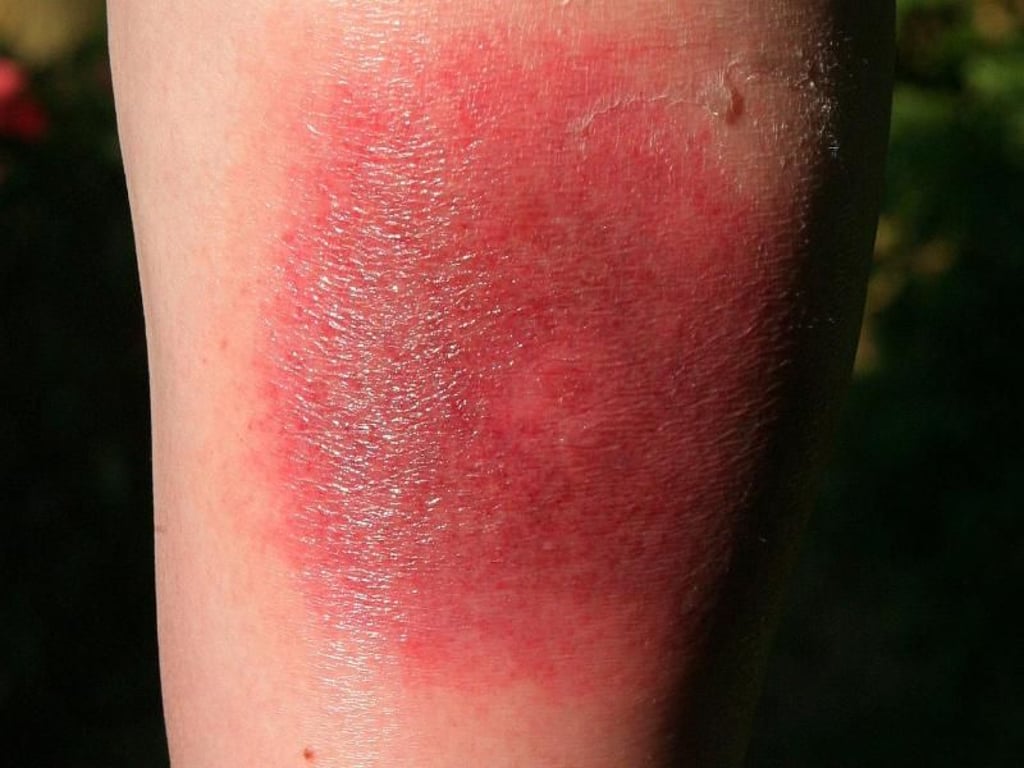 Klares Warnzeichen für Borreliose: Die sogenannte Wanderröte kann Tage oder Wochen nach einem Zeckenstich auftreten. Foto: Harry Melchert
