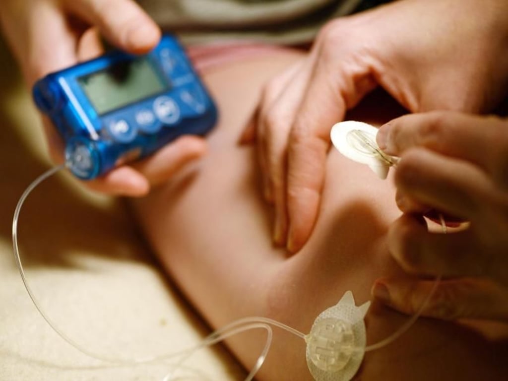 Viele Insulinpumpen sind über einen Schlauch mit einem Katheter verbunden. Darüber gelangt das Insulin in den Körper. Foto: Jens Kalaene