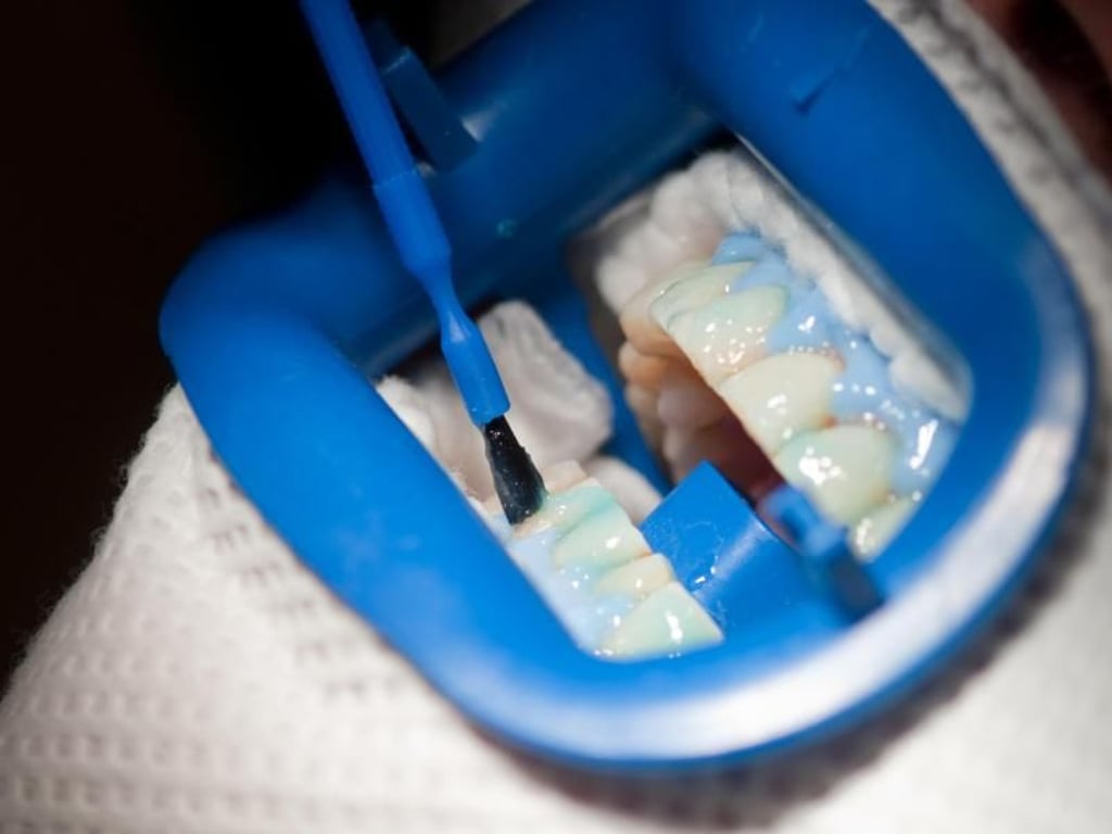 Auf die Zähne kommt beim Bleaching ein Bleichmittel - das blaue Gel schützt dabei das Zahnfleisch. Foto: Klaus-Dietmar Gabbert