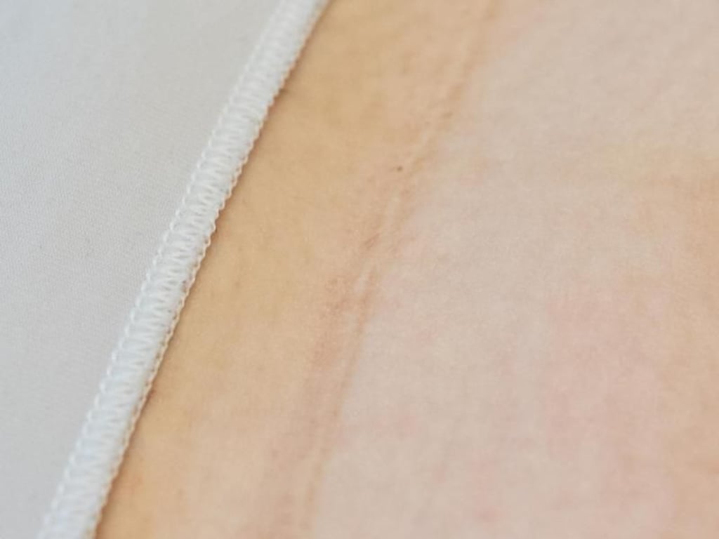 Mit Schmerzen müssen Frauen nach einem Kaiserschnitt schon rechnen. Ernsthafte Probleme mit der Wundheilung gibt es heute aber sehr selten. Foto: Karolin Krämer