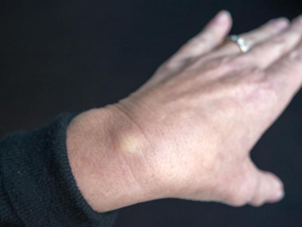 Woher ein Überbein - in der Fachsprache Ganglion - kommt, ist bislang nicht genau erforscht. Foto: Andrea Warnecke
