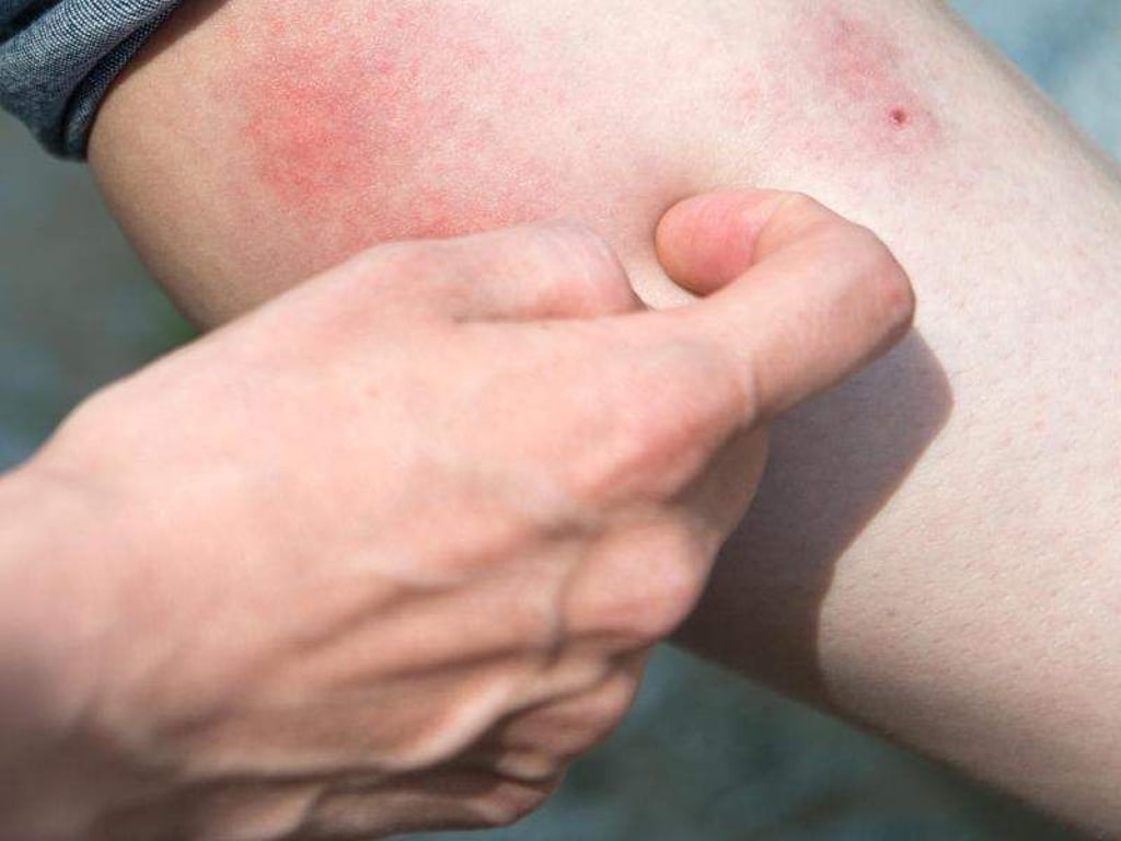 Wer seine Hautverletzung narbenfrei abheilen lassen möchte, sollte die Finger von ihr lassen. Foto: Andrea Warnecke