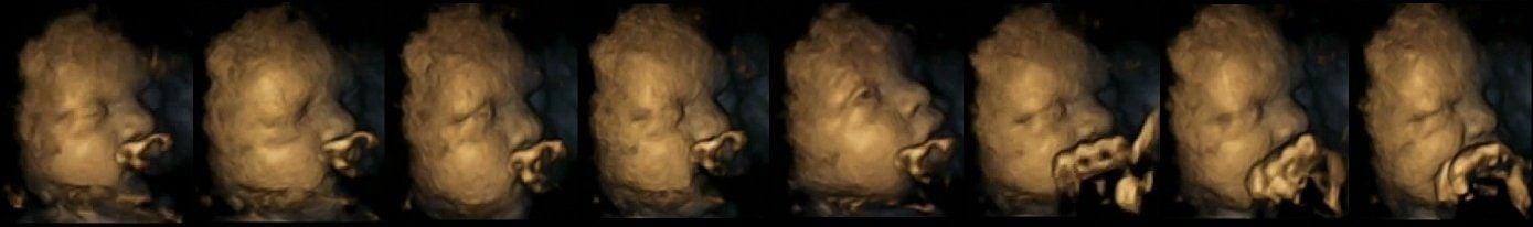 Deutlich ruhiger: der Fötus einer Nichtraucherin, aufgenommen mit einem 4-D-Ultraschall.