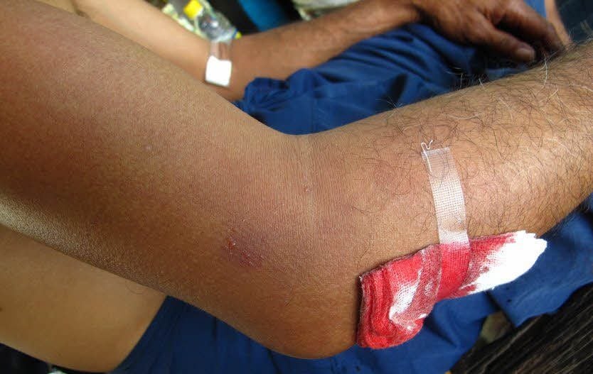 Der angeschwollene Arm nach der Attacke des Rochens.