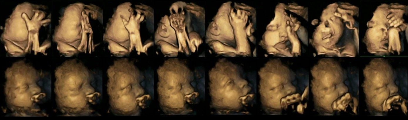 Stress im Uterus: Föten von Raucherinnen (oben im Bild) bewegen häufiger das Gesicht und berühren sich öfter als Ungeborene von Nichtraucherinnen (unten).