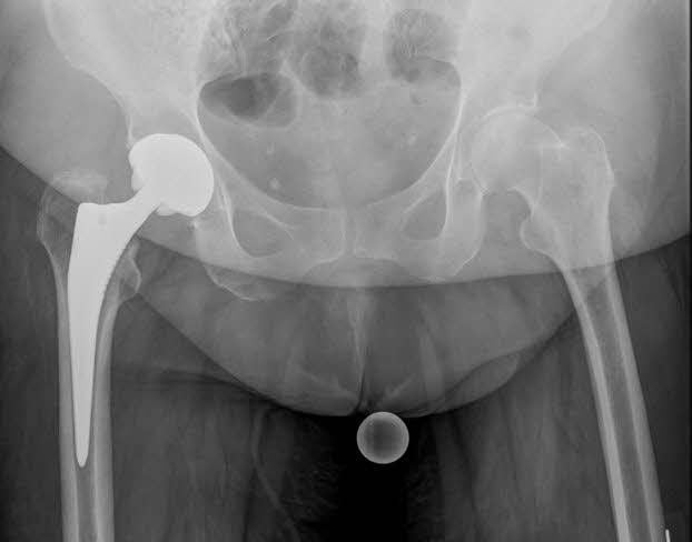 Das Städtische Klinikum Dessau hat im Qualitätsbericht 2013 der Ärztekammer Sachsen-Anhalt ein Top Ergebnis bei den Implantationen künstlicher Knie- und Hüftgelenke erhalten.