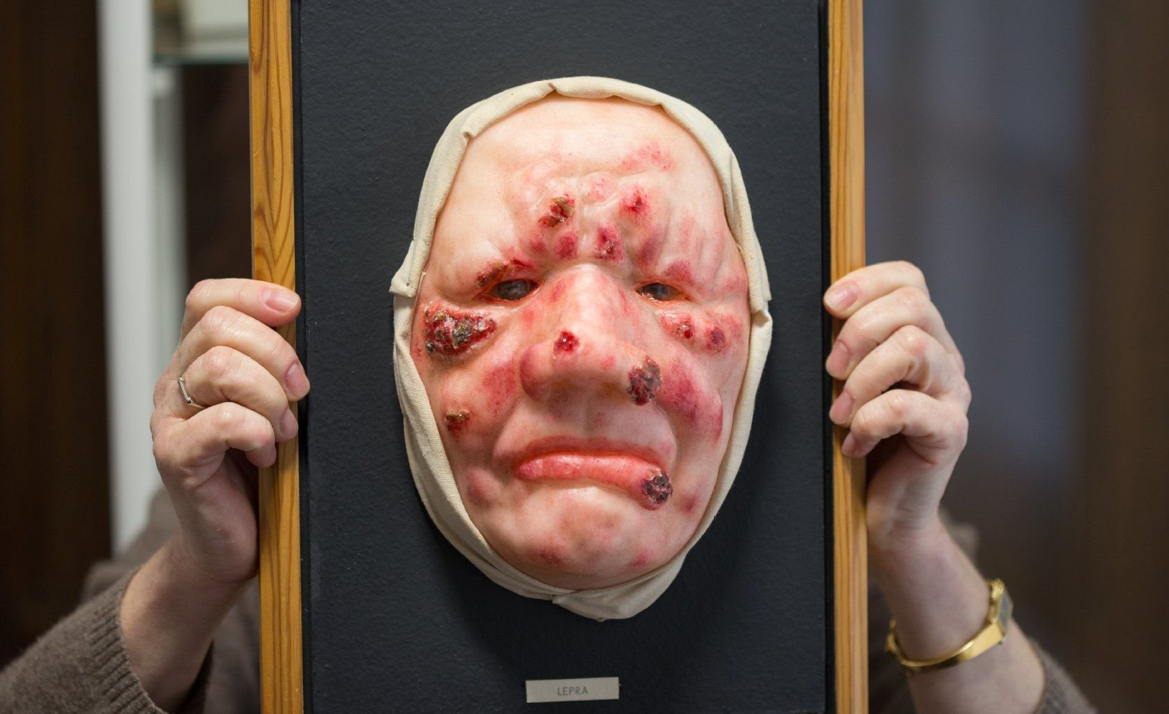Diese Gesichtsmaske aus Wachs im Lepramuseum in Münster veranschaulicht die Krankheitssymptome von Lepra.