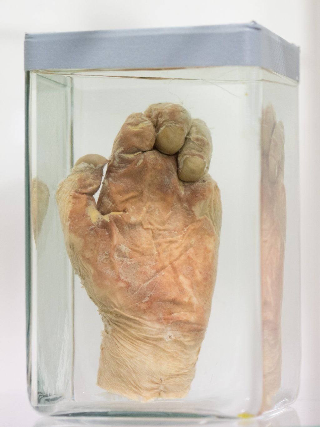 Das Präparat einer Hand im Lepramuseum veranschaulicht die Krankheitssymptome von Lepra.