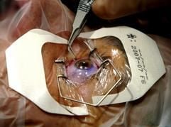 Augenarzt Suphi Taneri führt am Dienstag (16.09.2003) im Zentrum für Refraktive Chirurgie am Franziskus-Hospital in Münster eine Augenoperation durch. Dabei hebt er die vorher kreisrund angeschnittene Hornhaut des Auges unmittelbar vor dem Lasereinatz mit einer Pinzette an. Anschließend wird in einem wenige Sekunden dauernden Lasereinsatz der Sehfehler korrigiert und die Hornhaut mit einer Kontaktlinse zur Heilung fixiert, die bereits nach einem Tag abgeschlossen ist. Die gesamte ambulante Operation ist mit 20 Minuten sehr kurz, der Laser kommt dabei weniger als eine Minute zum Einsatz. Taneri korrigiert mit Hilfe eines Lasers Sehfehler und sorgt dafür, dass seine Patienten ihre Sehhilfen einmotten können. (Foto: dpa)