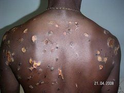 Ein Folter-Opfer in Simbabwe. Der Mann berichtete, Millizionäre hätten mit Benzin gefülltes Plastik auf seinem Rücken in Brand gesteckt. (Foto: dpa)
