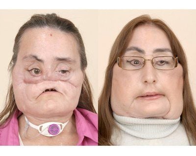 Connie Culp vor (links) und nach der Operation. (FOTO: DPA)