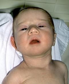 Das Foto zeigt ein neugeborene Baby, das in einem Strandkorb auf der Nordsee-Insel Wangerooge ausgesetzt wurde (Foto vom 27.07.2003). (Foto: dpa)