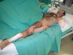 In einer ungewöhnlichen Rettungsaktion habenspanischen Ärzte einem verunglückten Kraftfahrer einen abgetrenntenArm für neun Tage an ein Bein genäht. (Foto: dpa)