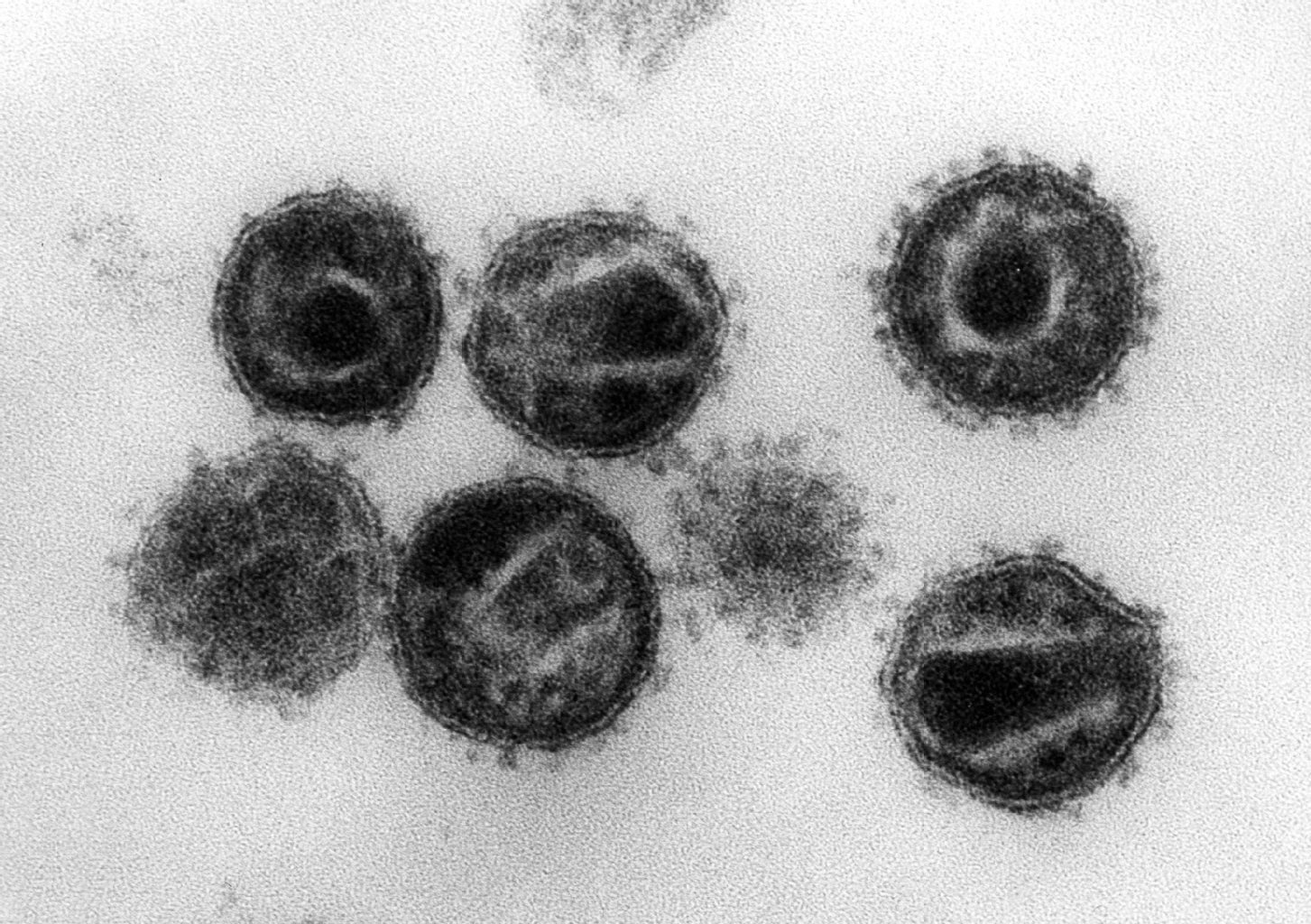 Eine undatierte elektronenmikroskopische Aufnahme zeigt mehrere Humane Immunschwäche-Viren (HIV). Im Kampf gegen Aids haben Ärzte in den USA einen aufsehenerregenden Erfolg vermeldet: Nach einer aggressiven Therapie mit antiretroviralen Medikamenten kurz nach der Geburt soll erstmals ein mit dem HI-Virus infiziertes Baby weitgehend geheilt worden sein.