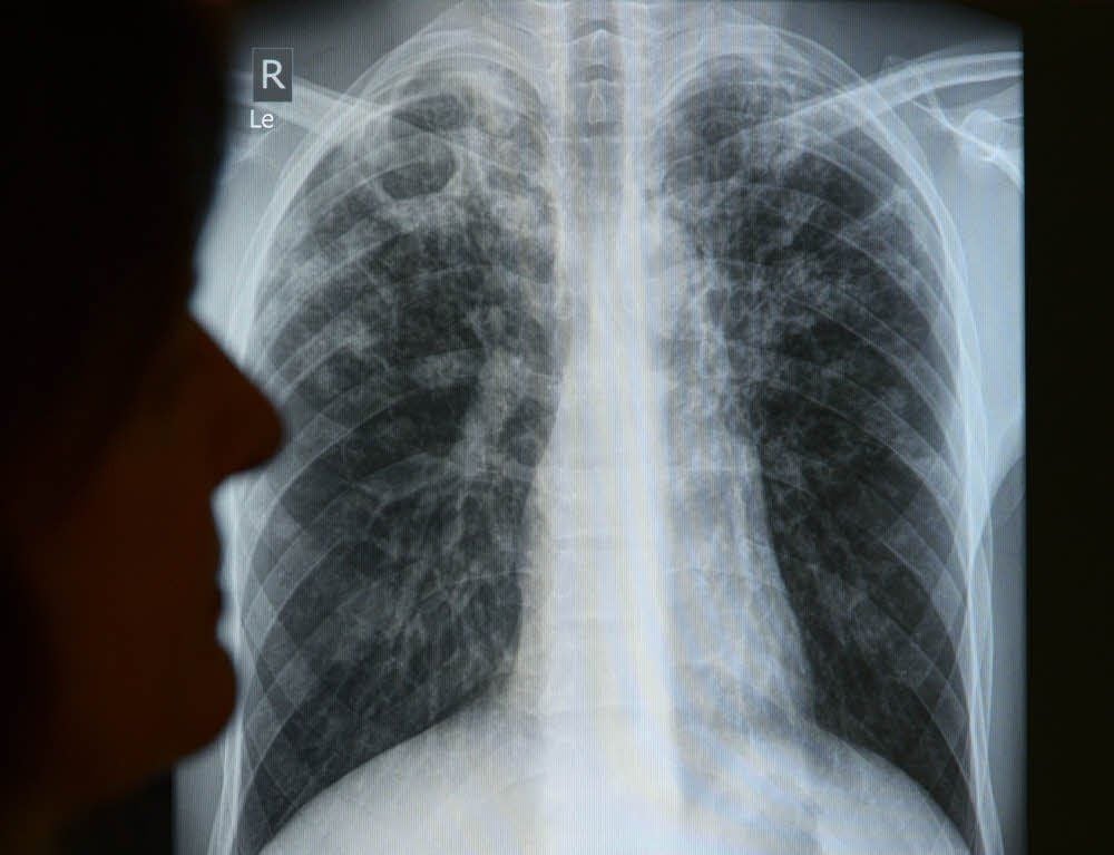 Die Röntgenaufnahme zeigt deutliche Verschattungen in der Lunge - ein Zeichen für Tuberkulose.