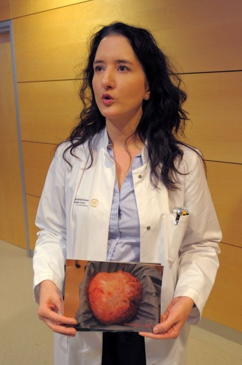 Die Direktorin der Klinik für Frauenheilkunde und Geburtshilfe des Universitätsklinikums in Dresden, Pauline Wimberger, präsentiert Fotos des 28 Kilogramm schweren Tumors. (FOTO: DPA)