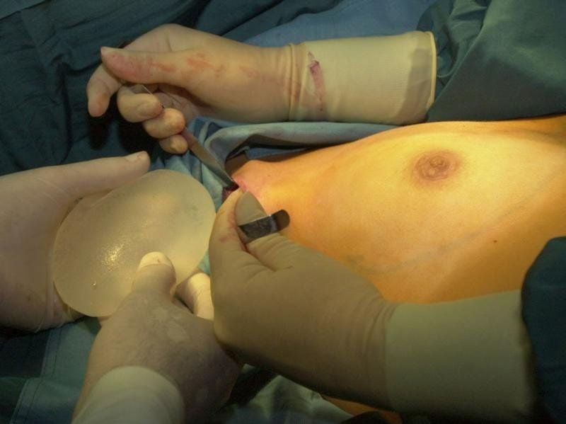 Allein in Deutschland haben sich mehr als 5000 Frauen billige Implantate der Firma PIP einsetzen lassen.