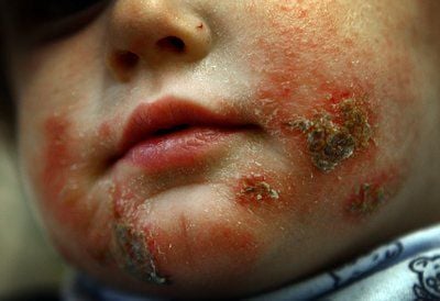 Ein Kind zeigt in der Kinderklinik in Köln seine mit Neurodermitis befallenen Körperpartien. (FOTO: DPA)