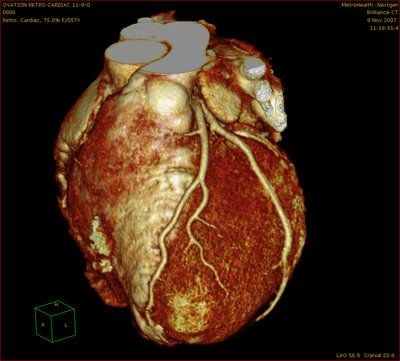 Die von einem neuen Computertomographen (Ct) produzierte Aufnahme eines Herzens. (Foto: dpa)