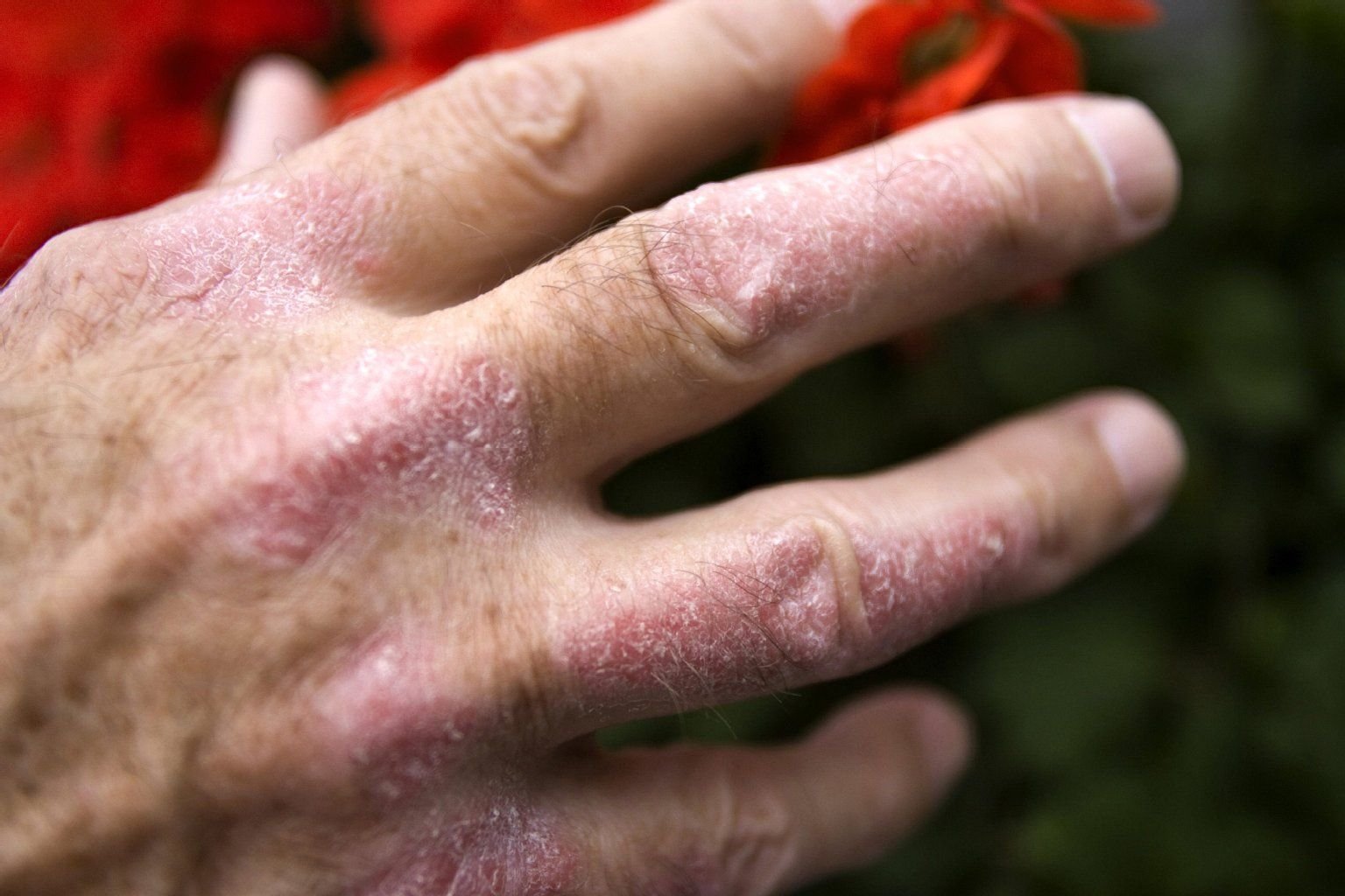 Rote Flecken auf der Haut, die sich mit der Zeit verdicken, und darauf helle Schuppen - das sind die wichtigsten Symptome bei Schuppenflechte (Psoriasis).