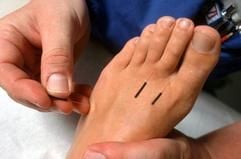 Immer noch nicht völlig anerkannt - die Kassen übernehmen die Kosten für Akupunktur in der Regel nur bei chronischen Knie- und Rückenschmerzen. (Foto: dpa)