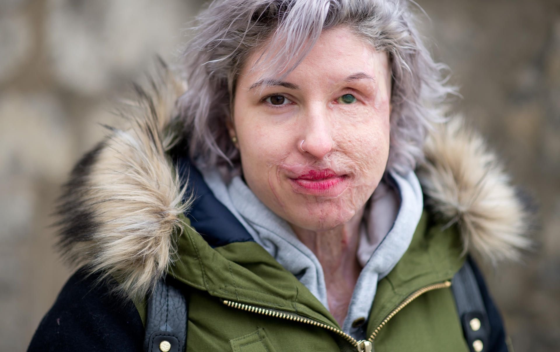 Ein Jahr nach der Säureattacke auf sie gründet Vanessa Münstermann den Verein „AusGezeichnet“.