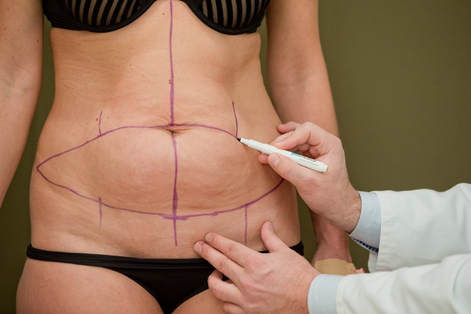 Vor der Operation zeichnet Dr. Jens Baetge, Facharzt für plastisch-ästhetische Chirurgie und Chefarzt an der Nürnberger Klinik für Ästhetisch-Plastische Chirurgie, die Bauchdeckenstraffung vor.