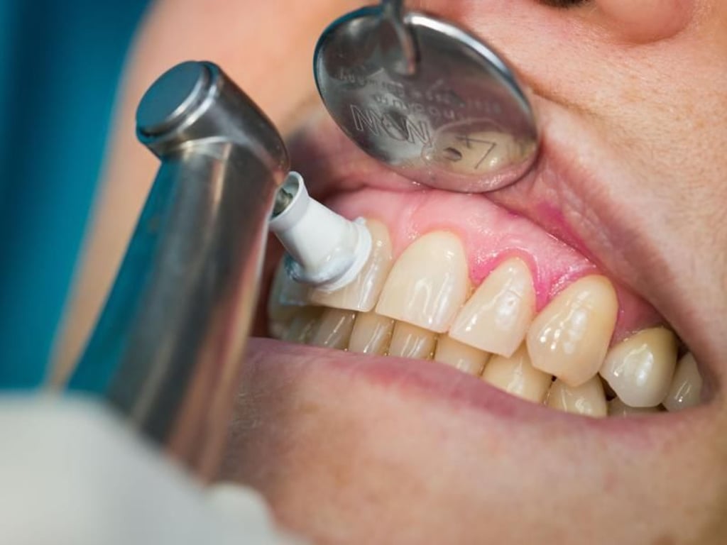 Bei der professionellen Zahnreinigung werden die Zähne nach der Reinigung mit einer fluoridreichen Paste poliert. Foto: Frank Rumpenhorst