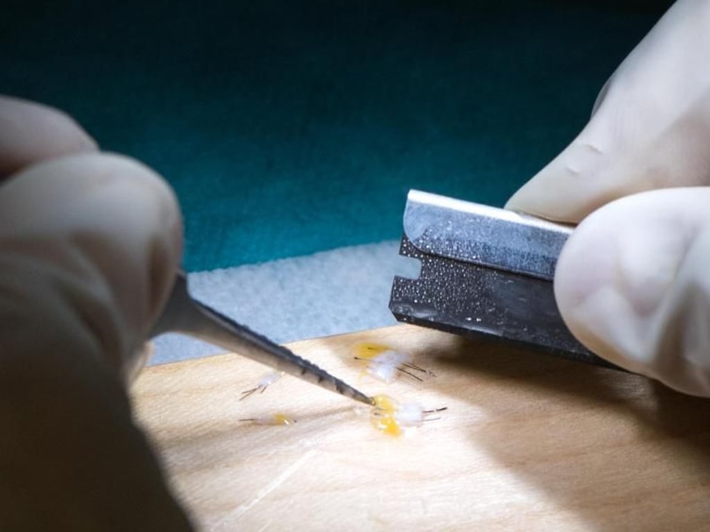 Unter einem Mikroskop werden feine Haareinheiten aus dem entnommenen Hautstreifen für die nachfolgende Transplantation herausgetrennt. Foto: Andrea Warnecke