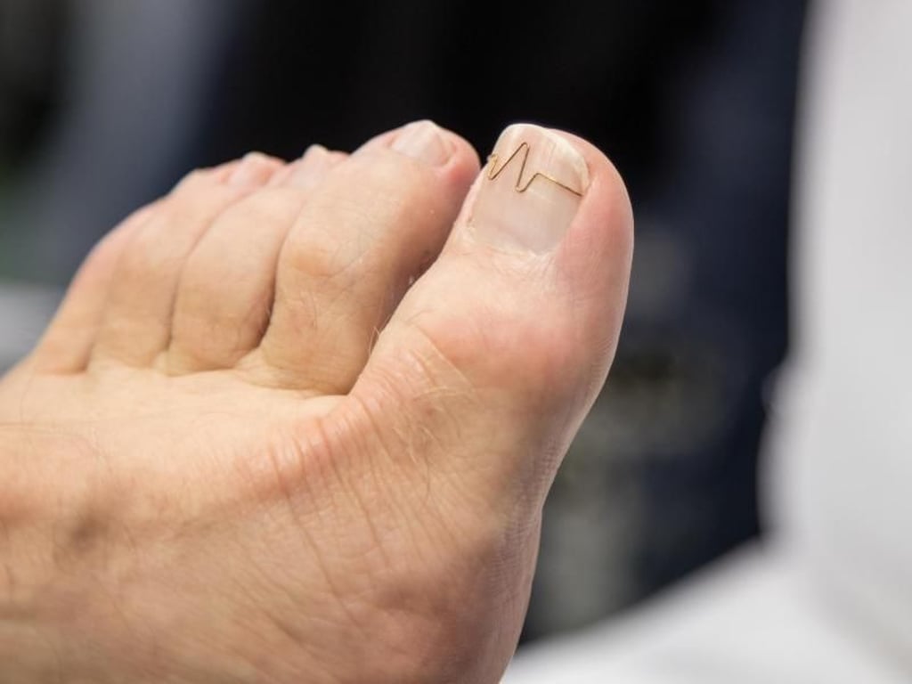 Ist ein Zehennnagel eingewachsen, helfen manchmal solche Nagelkorrekturspangen. Foto: Christin Klose/dpa Themendienst/dpa-tmn