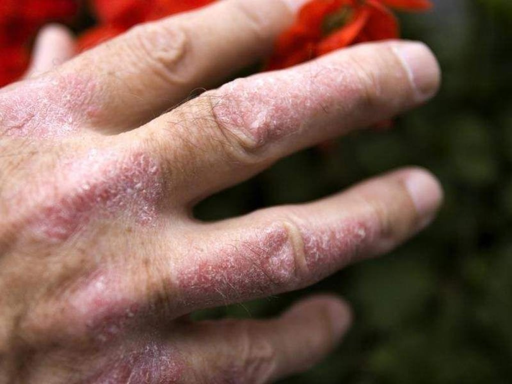 Rote Flecken auf der Haut, die sich mit der Zeit verdicken, und darauf helle Schuppen - das sind die wichtigsten Symptome bei Schuppenflechte (Psoriasis). Foto: Arno Burgi