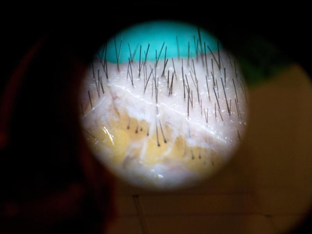 Unter dem Mikroskop lassen sich gut die Haare in dem einer Patientin entnommenen Hautstreifen erkennen. Sie werden nun einzeln aufbereitet und an kahle Stellen transplantiert. Foto: Andrea Warnecke