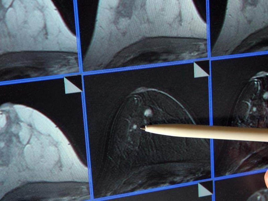 Wurde bei einer Frau Brustkrebs erkannt, ist oft nicht einzuschätzen, ob eine Chemotherapie hilft. Ein Biomarker-Test kann hier Klarheit schaffen. Foto: Jan-Peter Kasper