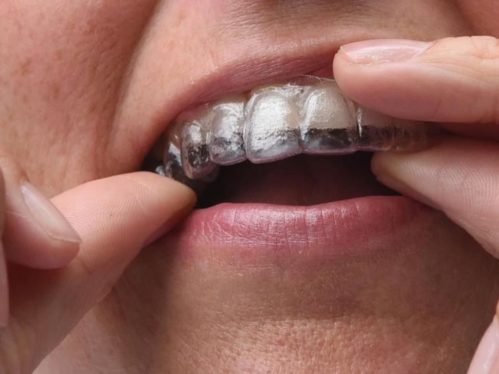 Da muss man zweimal hingucken: Clear Aligner sind eine Möglichkeit, sein Gebiss unauffällig zu korrigieren. Damit die Behandlung wirkt, muss man die Schiene regelmäßig tragen. Foto: Henning Kaiser