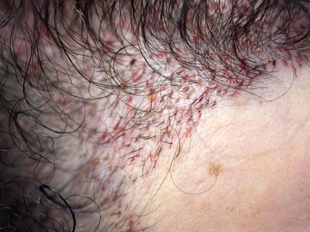 Die frisch eingesetzten Haareinheiten sind direkt nach der Transplantation an der Stirn einer Patientin noch gut zu erkennen. Foto: Andrea Warnecke