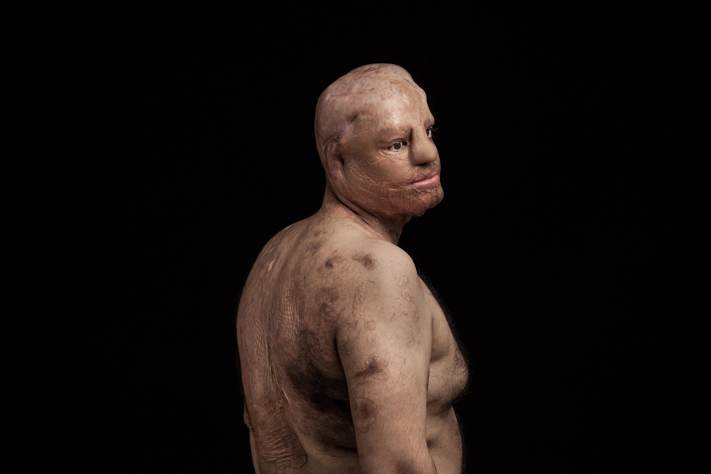 Für seine Serie „Fire of Hatred“ mit Bildern von männlichen und weiblichen Säureopfern wurde der Fotojournalist Asghar Khamseh ausgezeichnet.