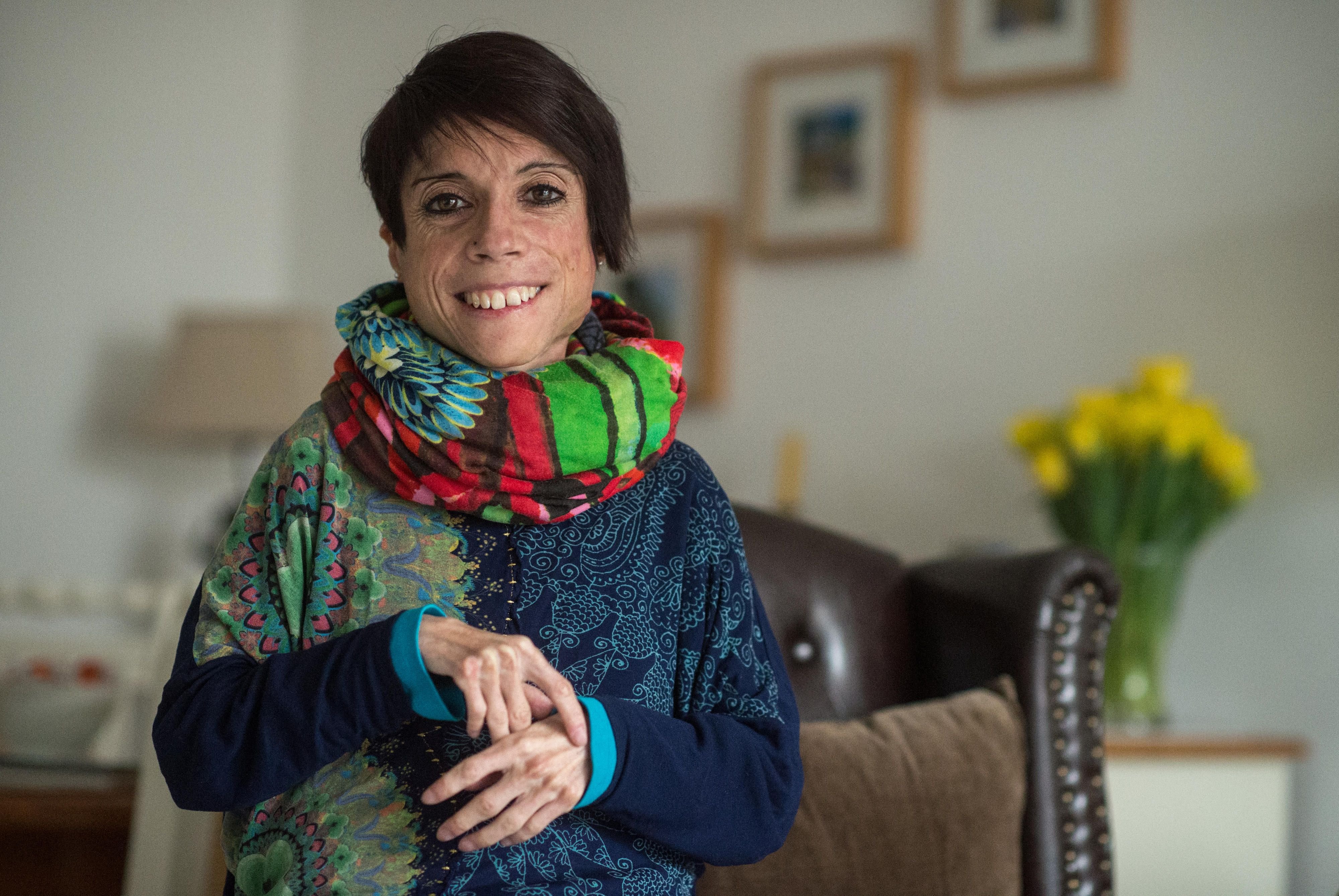 Concetta Tatti leidet an „Juvenile Dermatomyositis“.