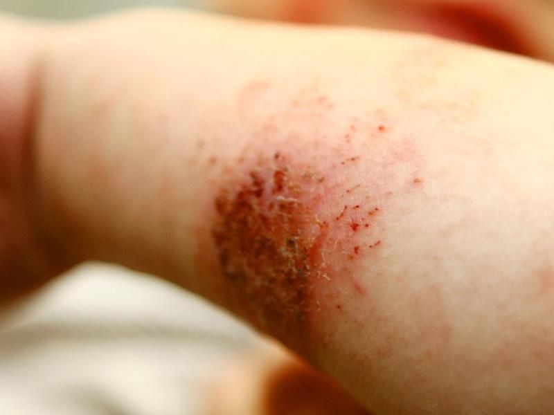 Wer an Neurodermitis erkrankt ist, sollte auf eine spezielle Kleidung und Hautpflege achten. Foto: Oliver Berg/dpa/tmn