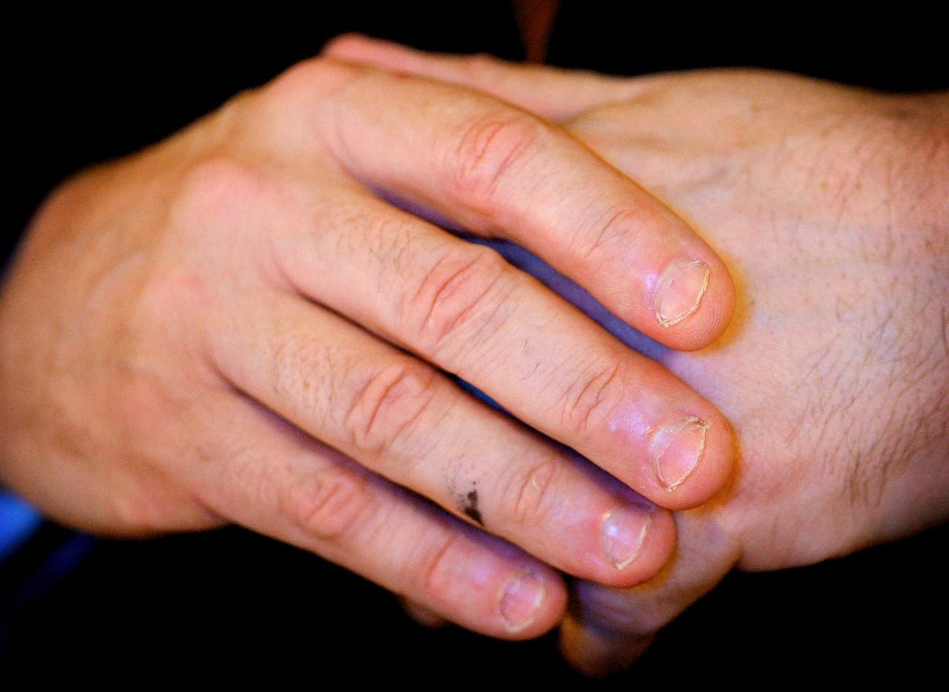 Symbolbild: Abgekaute Fingernägel sind keine Seltenheit und können sogar gefährlich werden.