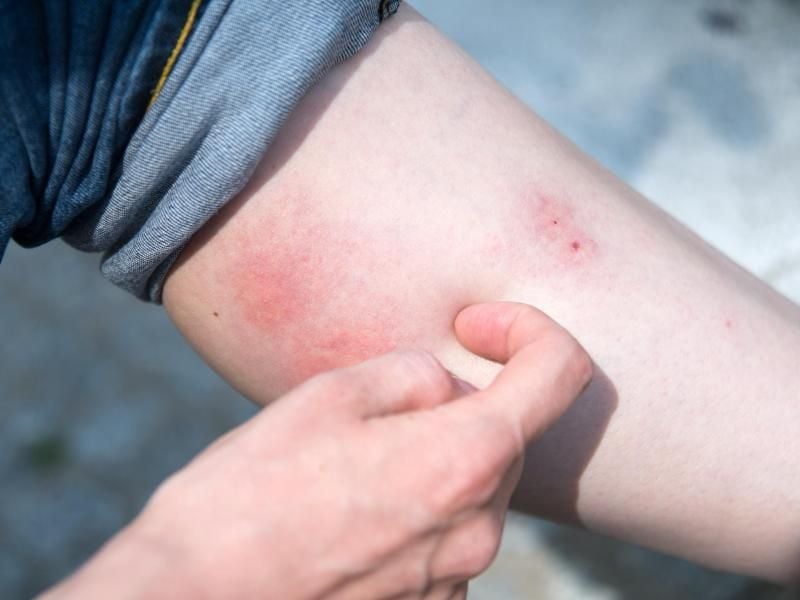 Bitte nicht kratzen! Mückenstiche werden besser gekühlt oder mit einem Präparat aus der Apotheke behandelt. Foto: Andrea Warnecke