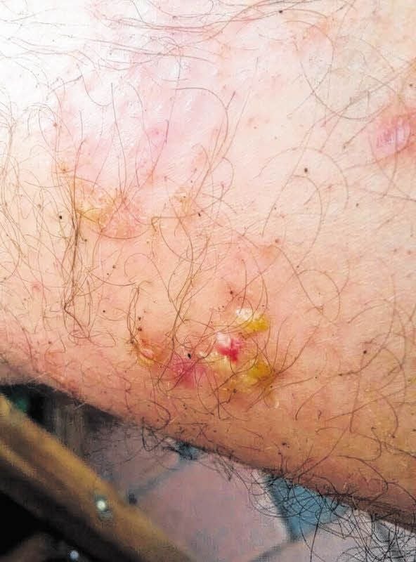 Foto vom Bein eines Feuerwehrmanns nach dem Fehr-Einsatz.