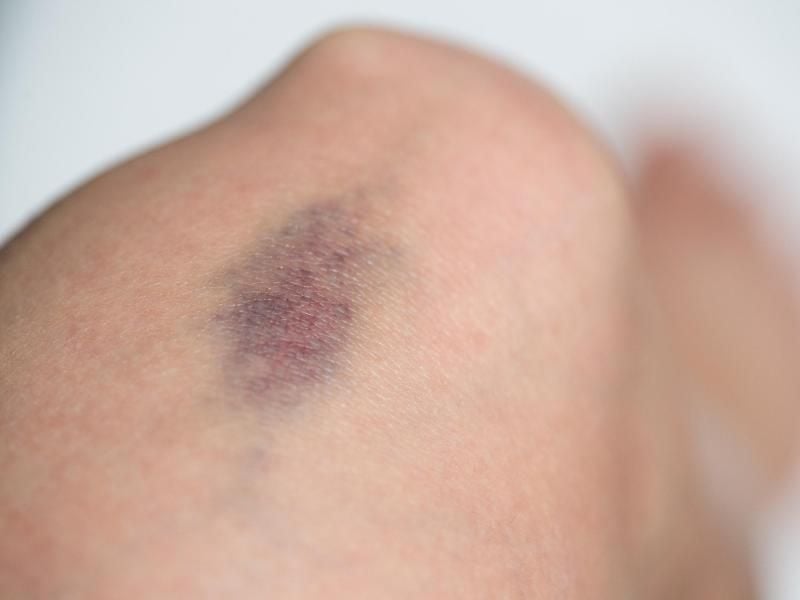 Wenn man öfter nach eher harmlosen Zusammenstößen blaue Flecken bekommt, kann das ein Anzeichen für eine Blutgerinnungsstörung sein. Foto: Andrea Warnecke/dpa-tmn