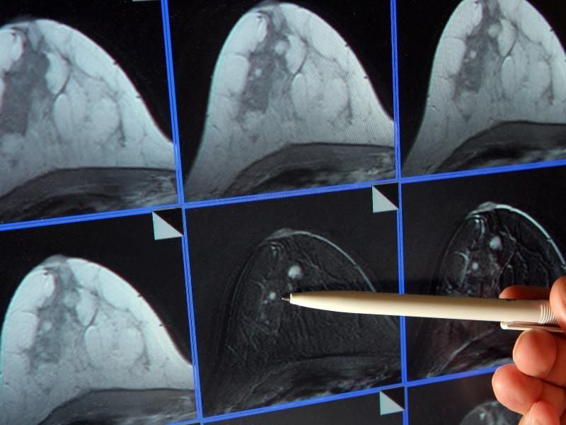 Auf der Bildschirmdarstellung einer Magnetresonanz-Mammographie ist ein winziger Tumor in der Brust einer Patientin zu sehen. Foto: Jan-Peter Kasper