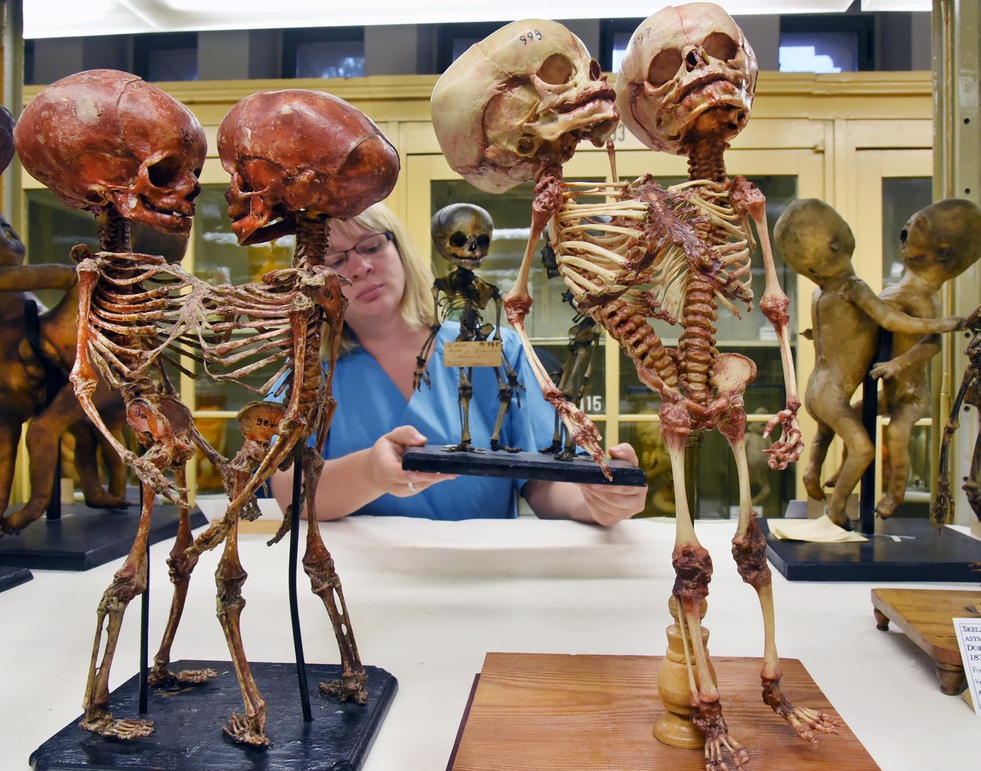 Die medizinische Präparatorin Julia Hallasch steht in den Meckelschen Sammlungen des Instituts für Anatomie und Zellbiologie der Martin-Luther-Universität Halle-Wittenberg an präparatorisch behandelten Skeletten von siamesischen Zwillingen aus den Jahren um 1815.