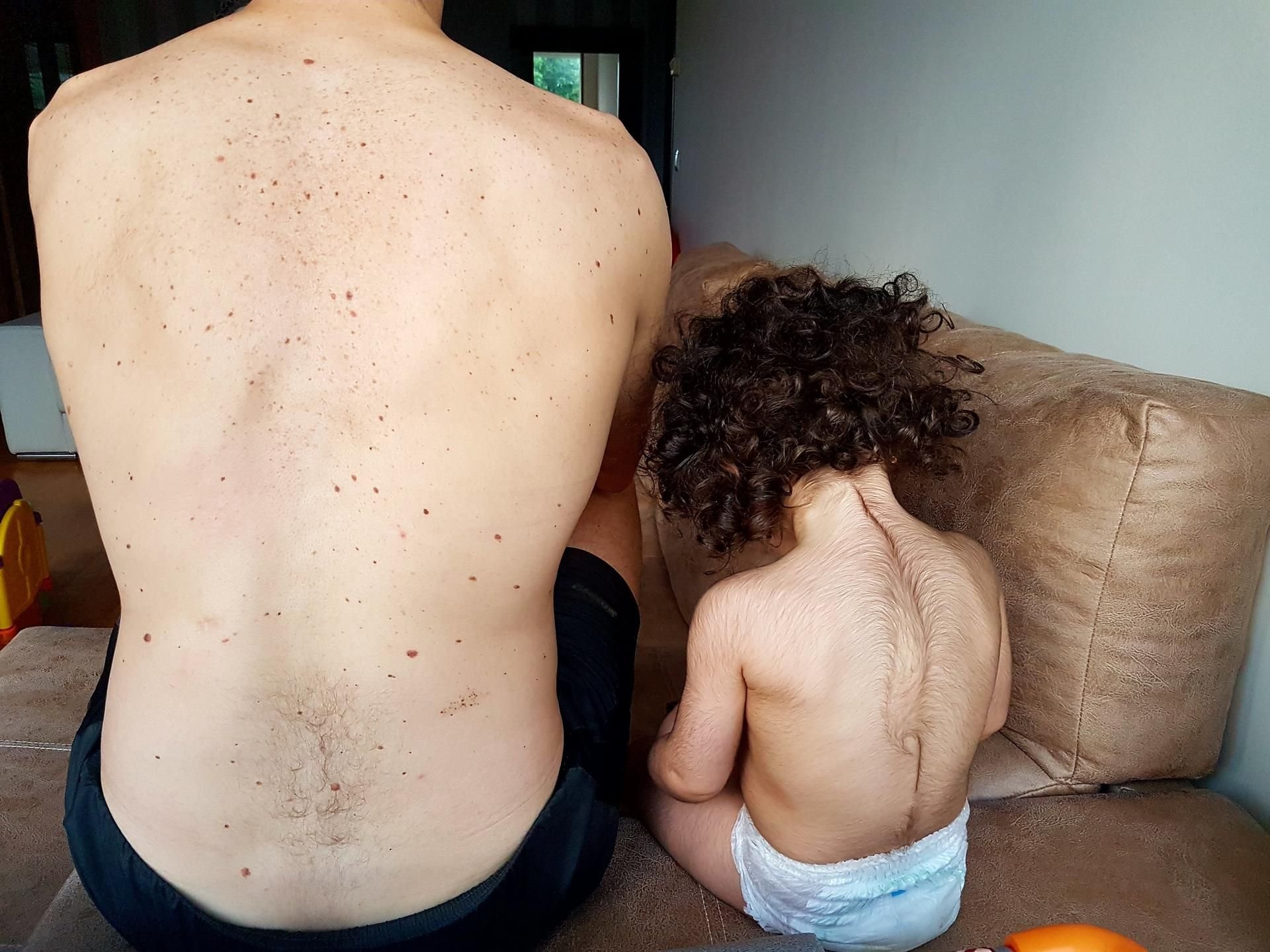 Ein Mädchen, das vom sogenannten «Werwolf-Syndrom» (Hypertrichose) betroffen ist, nachdem es mit dem falschen Medikament behandelt wurde, sitzt neben ihrem Vater. Die Verabreichung eines falschen Medikaments hat in Spanien bei zahlreichen Babys zu ungewöhnlich starkem Haarwuchs am Gesicht, Rücken und an anderen Körperstellen geführt.