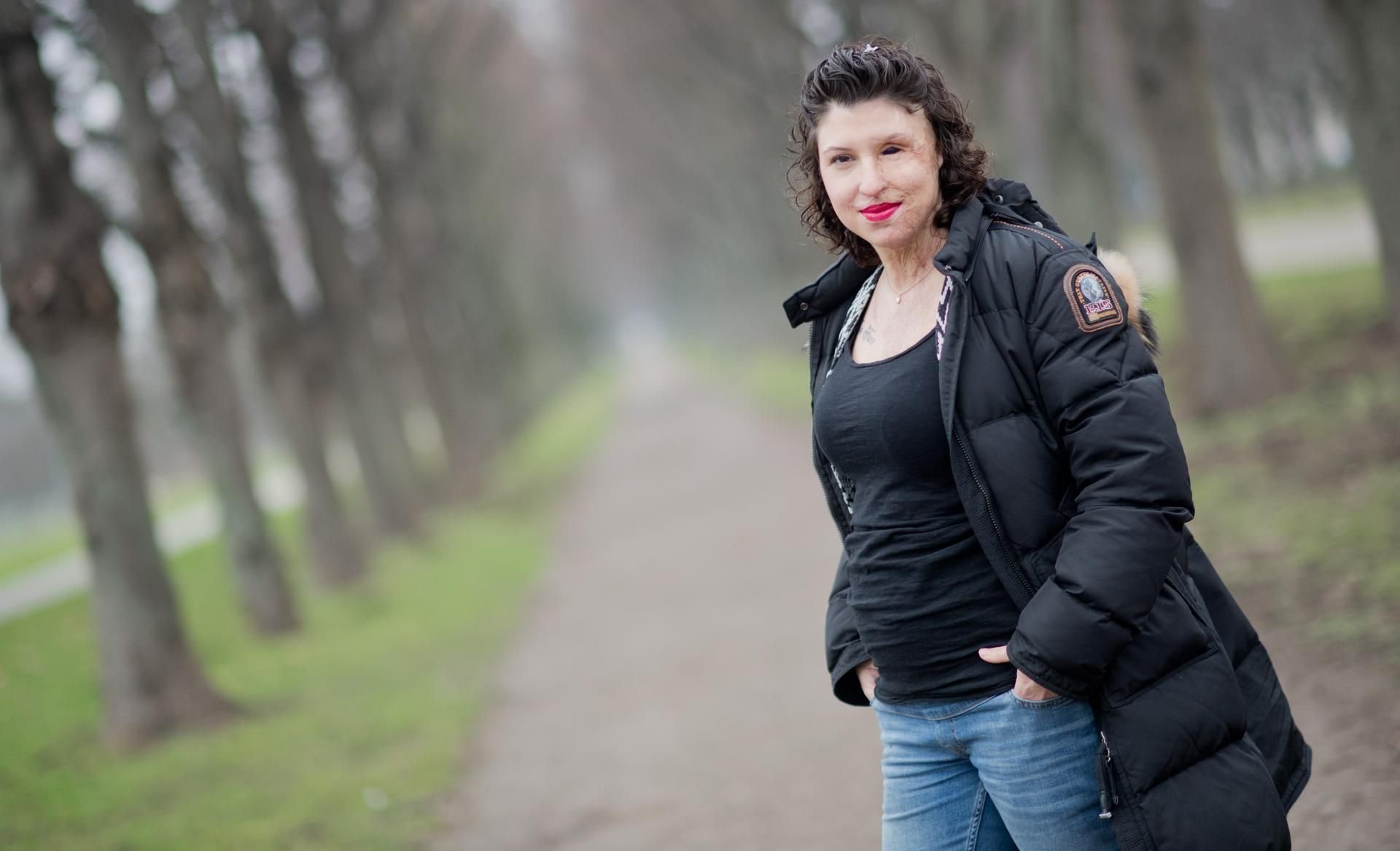 Vanessa Münstermann ist vor zwei Jahren Opfer einer Säureattacke geworden.