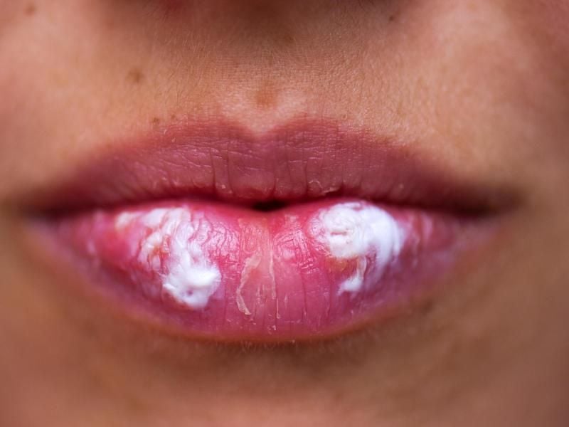 Der Herpesvirus ist leicht übertragbar. Für Babys und Kleinkinder kann der Virus nicht nur lästig sondern auch gefährlich sein. Foto: Arno Burgi/dpa-Zentralbild
