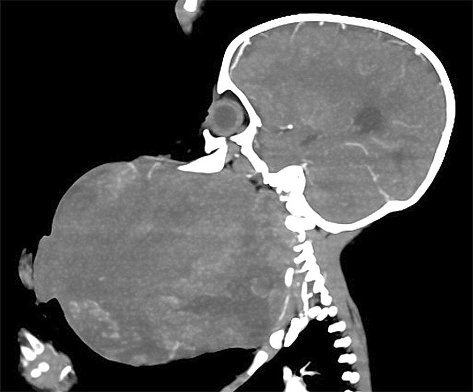 Die Computertomografie zeigt: Der Tumor (links) war größer als der Kopf des kleinen Kindes.